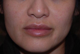 Juvederm to Lips and Smile Lines