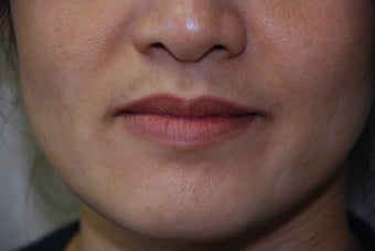 Juvederm to Lips and Smile Lines