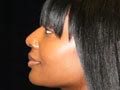 Atlanta Nose Job Surgery