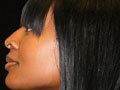 Atlanta Nose Job Surgery