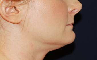 Neck Lift