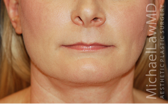 Neck Lift