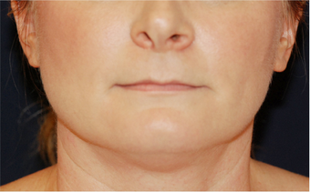 Neck Lift