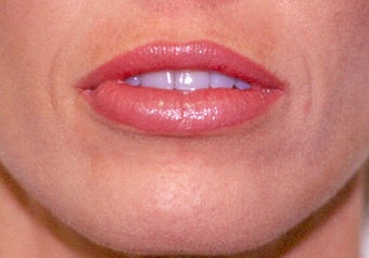 Before and After Upper & Lower Lip Lift