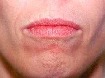 Before and After Upper & Lower Lip Lift