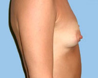 Breast Augmentation Corrects Saggy Breasts 