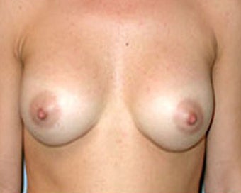 Breast Augmentation Corrects Saggy Breasts 