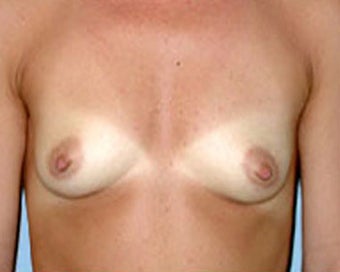 Breast Augmentation Corrects Saggy Breasts 
