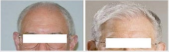 Hair Transplant 
