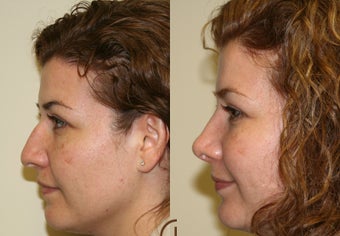 Nose job or Rhinoplasty