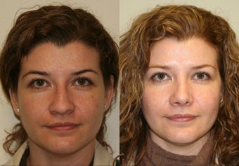 Nose job or Rhinoplasty