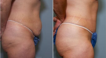 46 year old female with excess abdominal skin and laxity