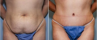46 year old female with excess abdominal skin and laxity