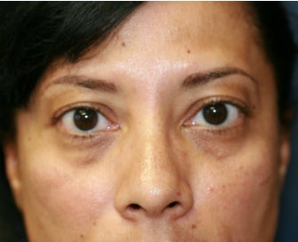 Radiesse to fill lower eyelid hollows