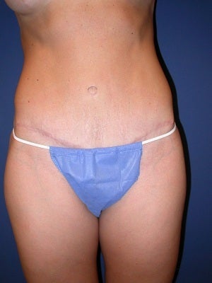 31 year old female, 5'7" 145 lbs.