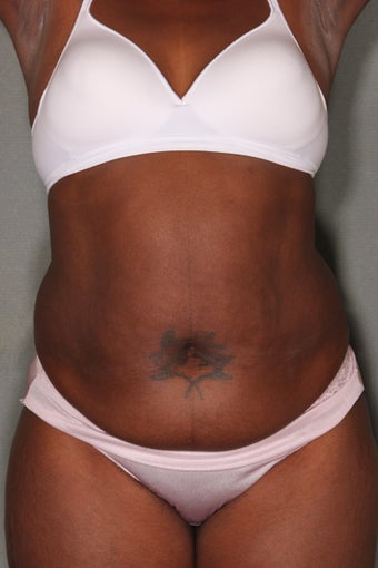 52 Year Old Female Treated for UnWanted Fat With SmartLipo and Vaser Laser