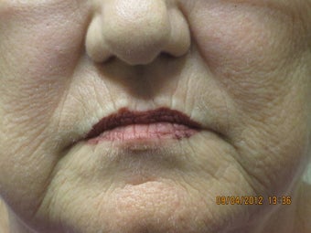 63 year old woman treated in perioral region with restylane 