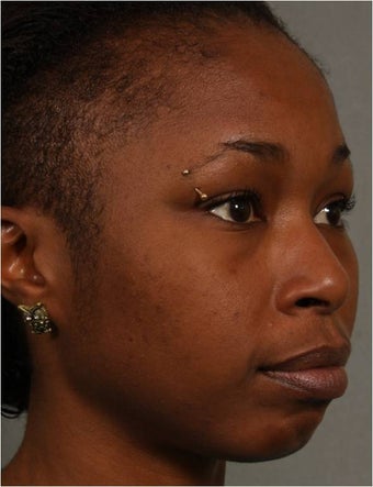 31 year old african american female with weak chin would like non surgical treatment