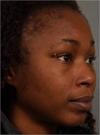 31 year old african american female with weak chin would like non surgical treatment