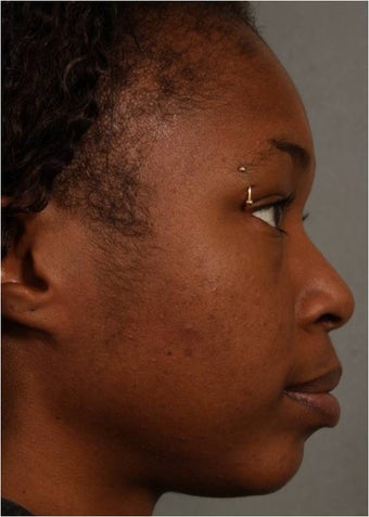 31 year old african american female with weak chin would like non surgical treatment