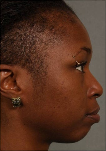 31 year old african american female with weak chin would like non surgical treatment