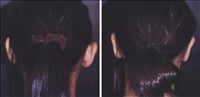 Ear Surgery