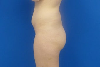 Brazilian Butt Lift via fat transfer