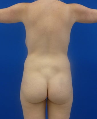 Brazilian Butt Lift via fat transfer