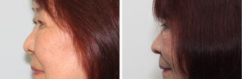 Before and 2 month after double eyelid surgery