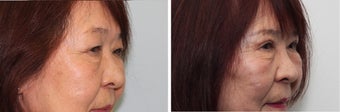 Before and 2 month after double eyelid surgery
