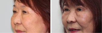 Before and 2 month after double eyelid surgery