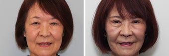 Before and 2 month after double eyelid surgery