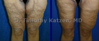 Leg Lift after weight loss surgery