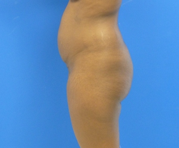 Brazilian Butt Lift - via fat transfer
