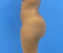 Brazilian Butt Lift - via fat transfer