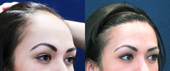 Forehead Reduction Surgery or Hairline Lowering Surgery