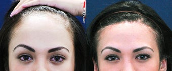 Forehead Reduction Surgery or Hairline Lowering Surgery