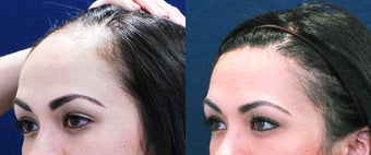 Forehead Reduction Surgery or Hairline Lowering Surgery