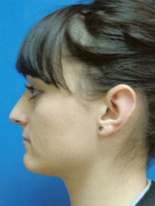 Otoplasty Ear Surgery - Female