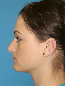Otoplasty Ear Surgery - Female