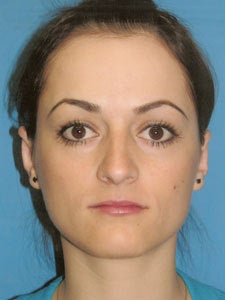 Otoplasty Ear Surgery - Female