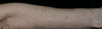 Fraxel 