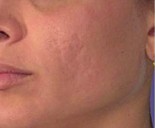Mesotherapy