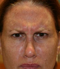 Botox