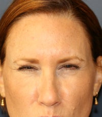 Botox