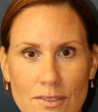 Botox