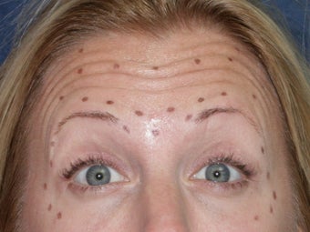 Before & After Botox