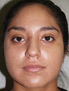 Vi-Peel for Acne