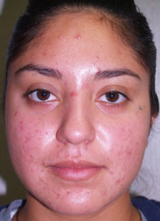 Vi-Peel for Acne