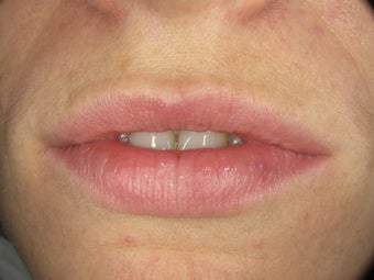 Teeth and Lips for Smile Makeover